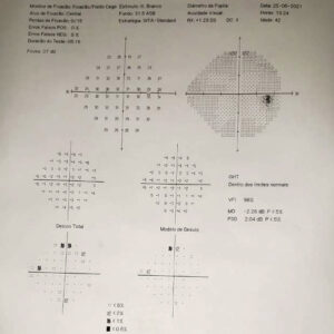 glaucoma-curitiba-1