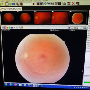 glaucoma-curitiba-2